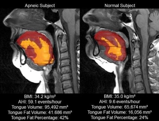 Cambios musculatura boca por apnea del sueño